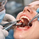 Tooth Removal Explained: Procedure, Risks & Recovery